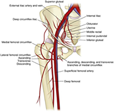 Perthes Disease