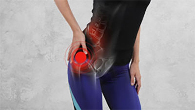 Perthes Disease