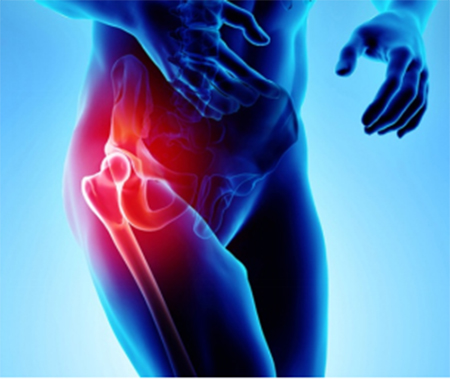 Hip Pain - 1 - Educational Photo