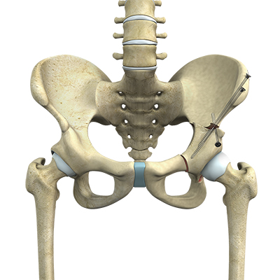 Hip Replacement