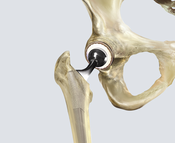 Hip Procedures