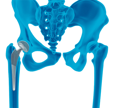candidate Hip Replacement