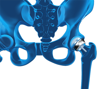 Hip resurfacing
