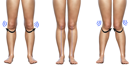 Hip Alignment Abnormalities - 1 - Educational Photo