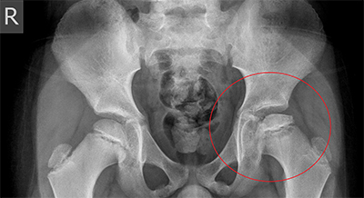 Perthes Disease