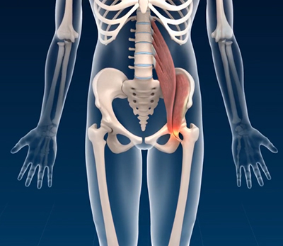 Cortisone Iliopsoas