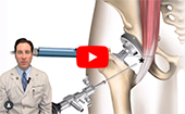 Interesting Case #3 iliopsoas impingement following a total hip arthroplasty treated by an iliopsoas fractional lengthening
