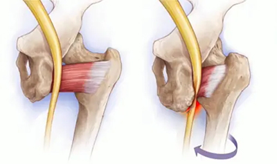 Ischiofemoral Impingement