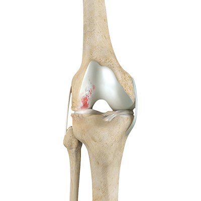 Knee Arthritis - 1 - Educational Photo