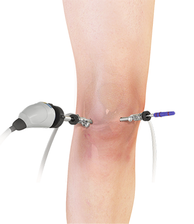 Knee Arthroscopy