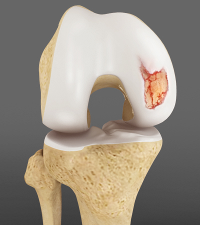 Cartilage Damage - 2 - Educational Photo