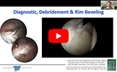 AANA Conference: Labral reconstruction with the Knotless Pull-Through Technique