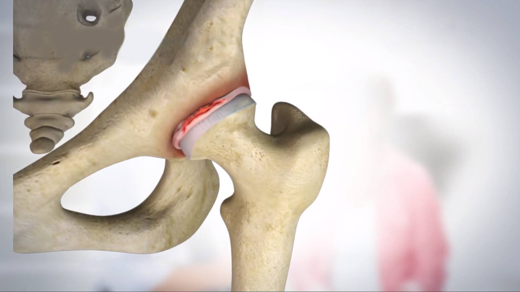 Advantages of Hip Arthroscopy