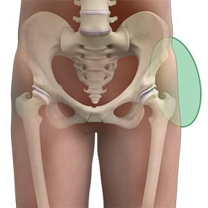 Hip Pain - 5 - Educational Photo