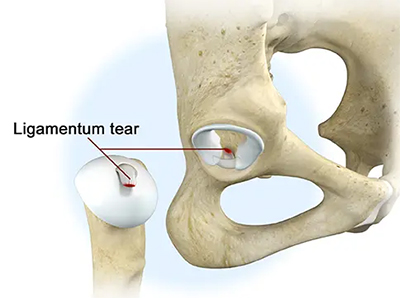 Ligamentum Teres Tears