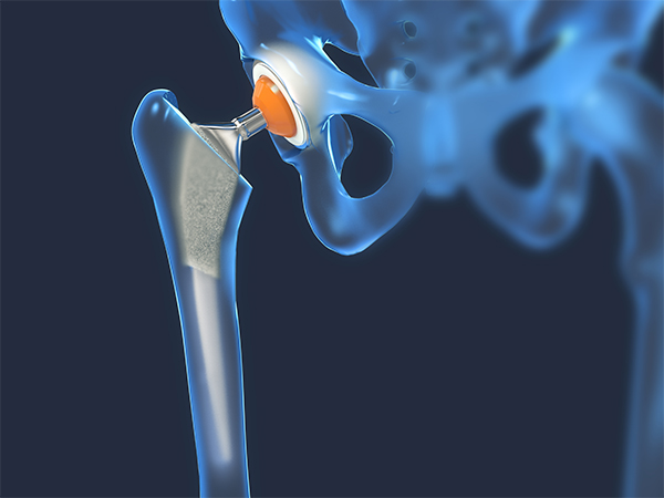 Minimally-Invasive Hip Replacement