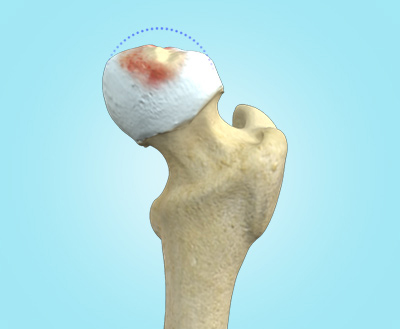 Perthes Disease