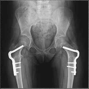Derotational Osteotomies - 3 - Educational Photo