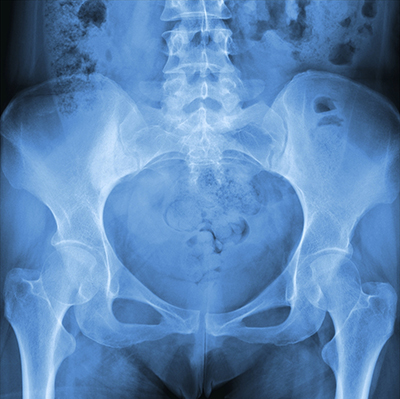 Athletic Pubalgia
