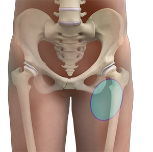 Hip Pain - 6 - Educational Photo