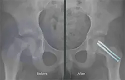 Slipped Capital Femoral Epiphysis