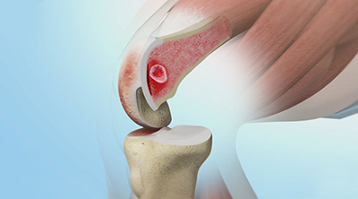 Subchondroplasty