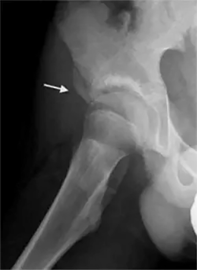 Subspine Impingement
