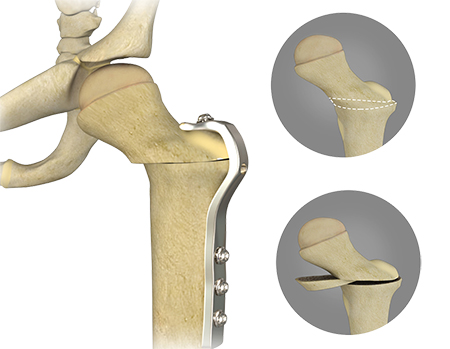Hip Alignment Abnormalities - 7 - Educational Photo