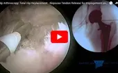 Hip Arthroscopy Total Hip Replacement - Iliopsoas Tendon Release logo