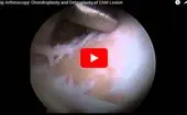 Hip Arthroscopy Chondroplasty and Osteoplasty of CAM Lesion logo