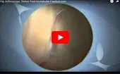 Hip Arthroscopy Status Post-Acetabular Fracture logo