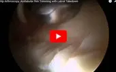 Hip Arthroscopy: Acetabular Rim Trimming with Labral Takedown logo