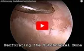 Hip Arthroscopy: Acetabular Microfracture logo
