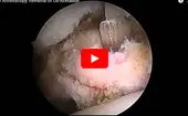 Hip Arthroscopy: Removal of Os-Acetabuli logo