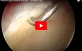 Hip Arthroscopy Chondral Damage The Wave sign logo