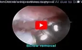 FAI after SCFE screw removal and osteoplasty logo
