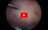 Trochanteric Micropuncture: Treatment for Gluteus Medius Tendinopathy logo