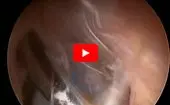 Gluteus Medius Repair: Double-Row Suture-Bridge logo