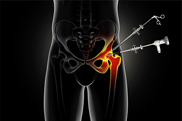 Minimally-Invasive Hip Arthroscopy
