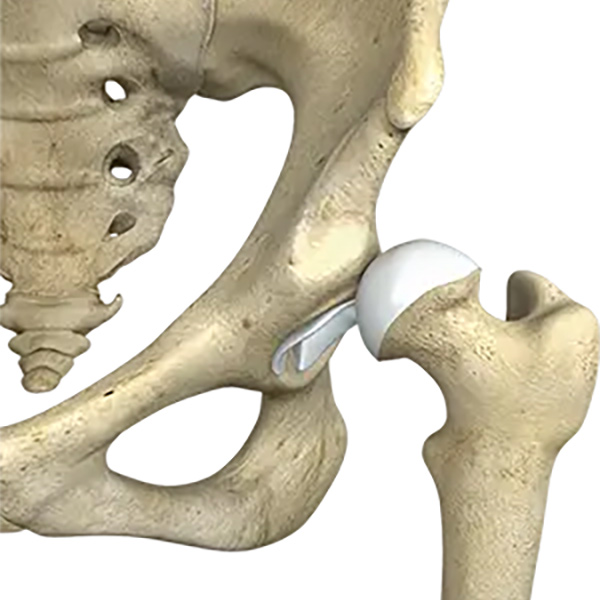 Frank Hip Dysplasia