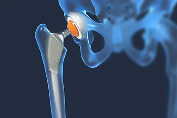 Hip Replacement