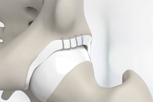 Labral Reconstruction