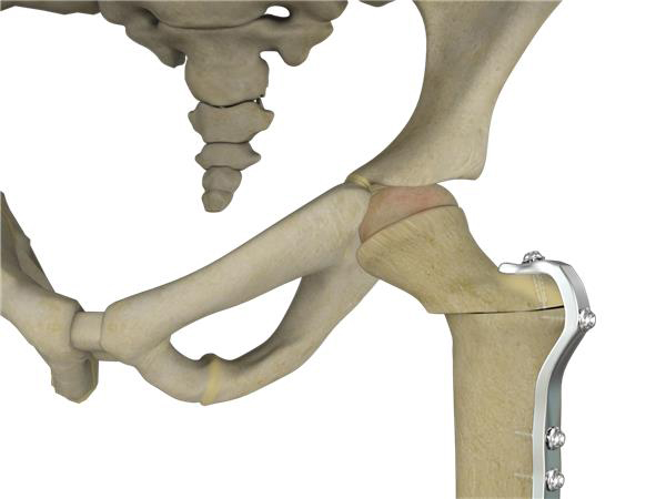 Osteotomy & Fracture Repair