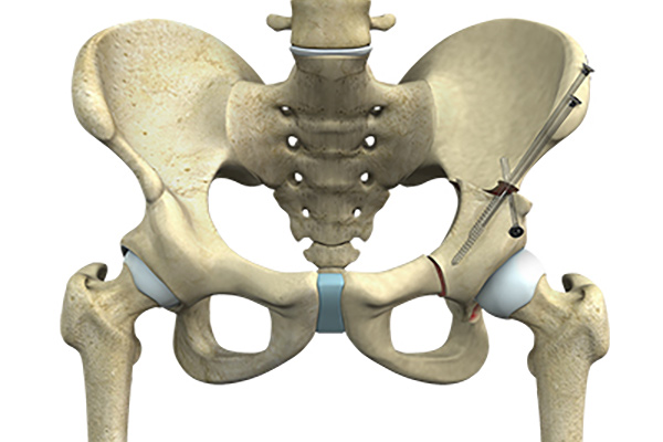 Peri Acetabular Osteotomy
