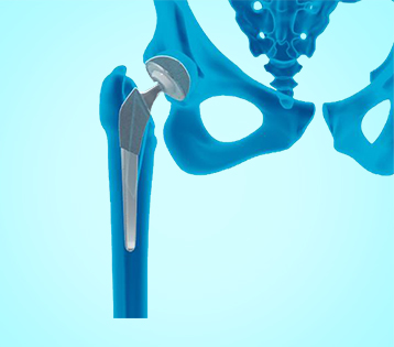 Hip Arthroscopy