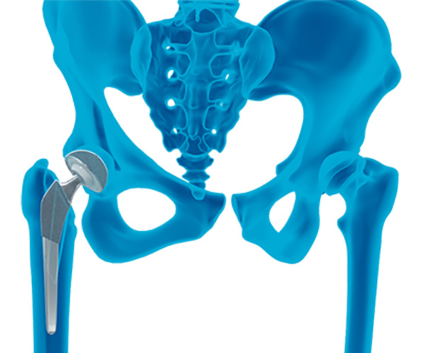 Robotic Hip Replacement
