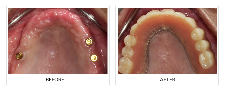 Denture