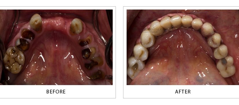 Full Mouth Implant