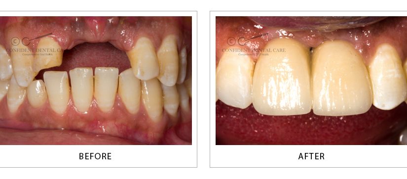 Full Mouth Implant