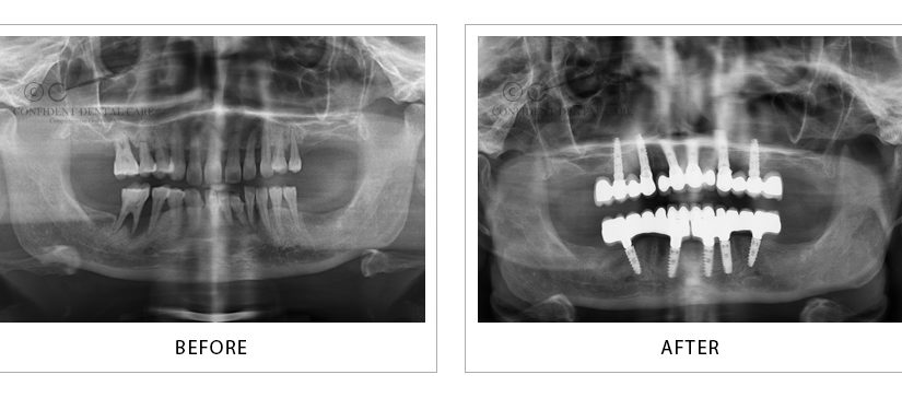 Full Mouth Implant